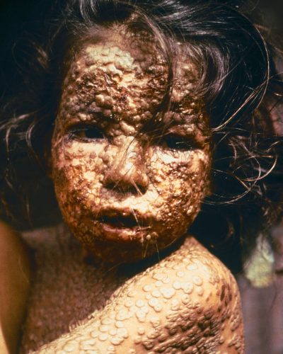 1200px-Child_with_Smallpox_Bangladesh